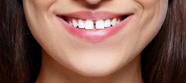 Diastema Closure in Pitampura