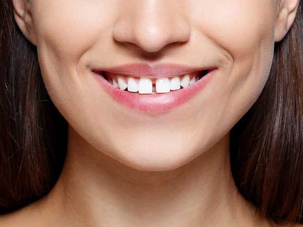 Diastema Closure in Pitampura