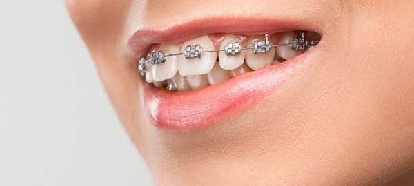 dental braces in Pitampura