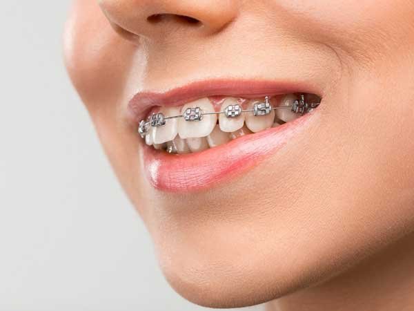 dental braces in Pitampura