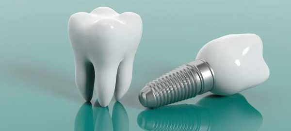 Best Dental Implant in Pitampura