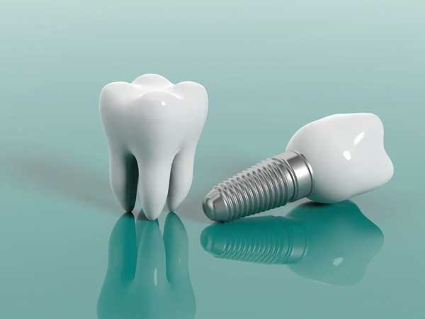 Best Dental Implant in Pitampura